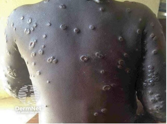 Malawi Lança Equtas Médicas para Travarpagaçaça do MPOX