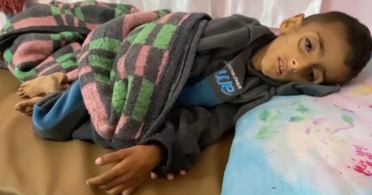 O médico de Gaza diz que a falta de comida e ajuda levou a