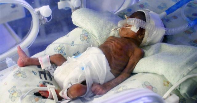Abordando a alta taxa de natalidade prematura da América