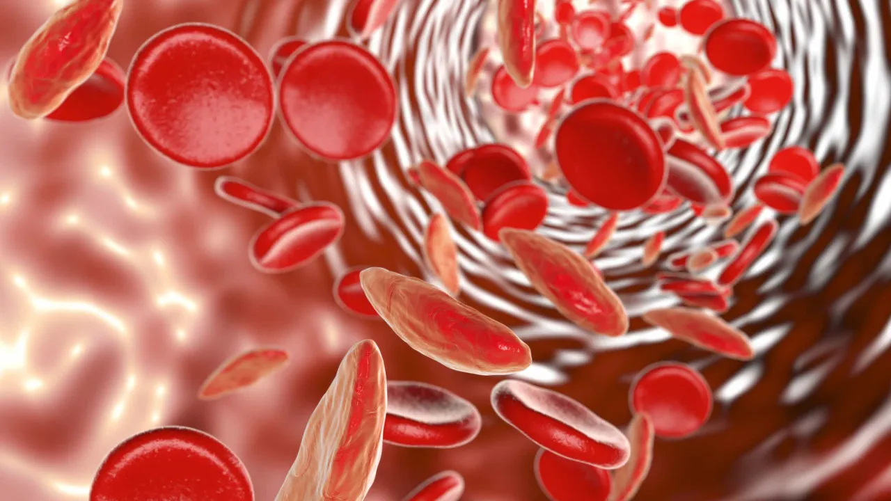 Drepanocitose. Uma doença que pode causar anemia severa