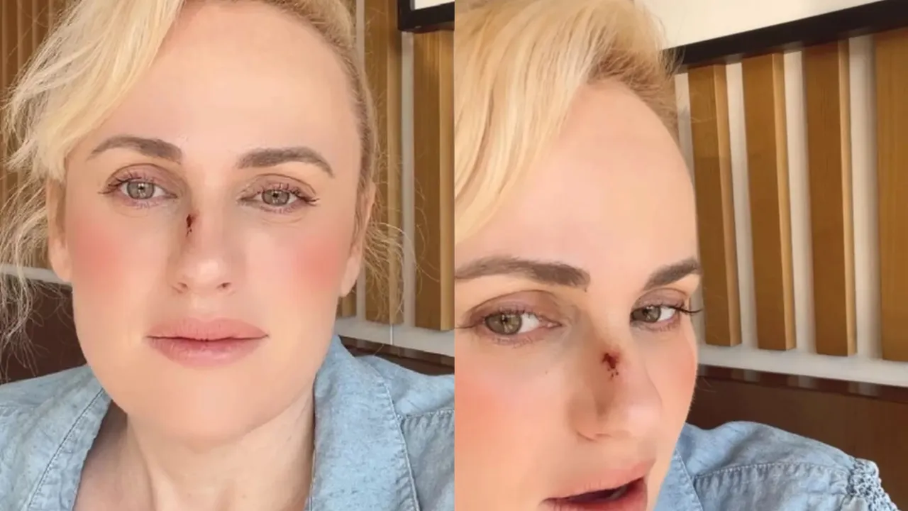 Rebel Wilson e o acidente no filme 'Bride Hard' que exigiu cirurgia