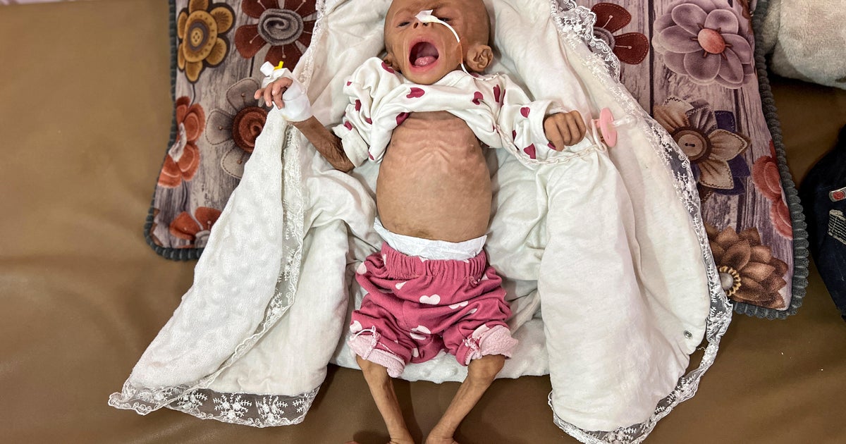O chefe do Hospital Gaza diz que 21 filhos morreram de desnutrição, St ...