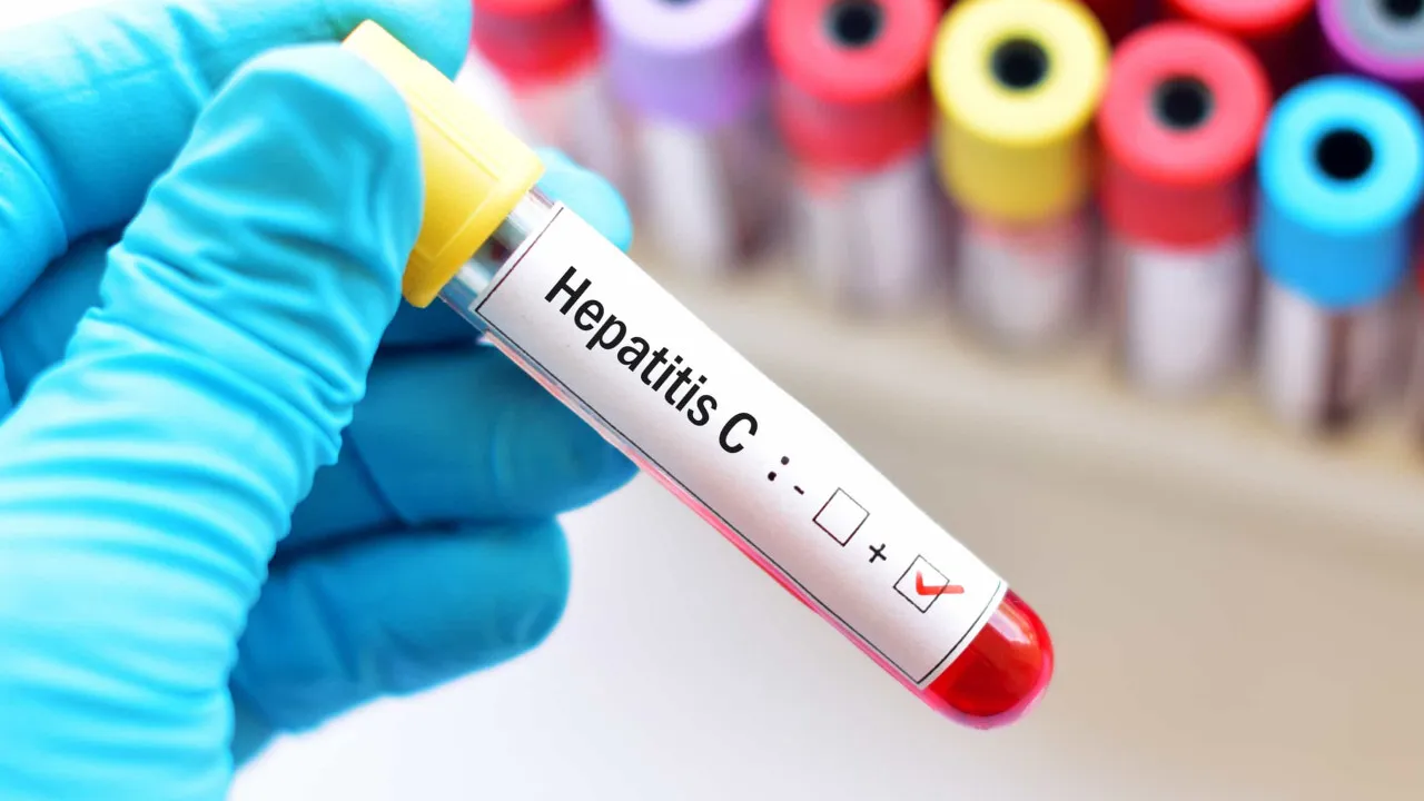 Tratamento para um hepatita C UltraPassam OS 36.300. Taxas de Cura 97%